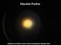 Vitrectomy for Macular Pucker Reg no 1356 2007
