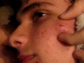 Brandons Cyst- Yumm!