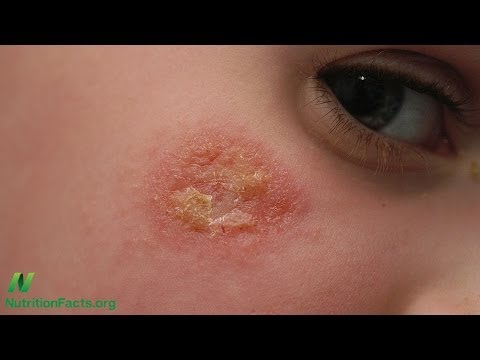 how to cure eczema with diet