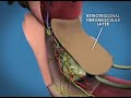 Weill Cornell Robotic Prostatectomy: Surgery (4/6)