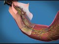 Weill Cornell Robotic Prostatectomy: Surgery (4/6) Weill Cornell Robotic Prostatectomy: Surgery (4/6)