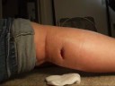 My dressing change for the staph infection on my calf