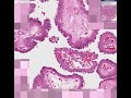 Histopathology Thyroid --Papillary carcinoma