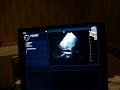 Ultrasound of my heart