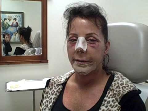 My Facial Plastic Surgery Blog - Recovery Day 4