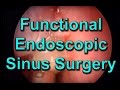 How is Endoscopic Sinus Surgery Performed?