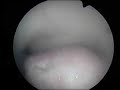 Polipo endometrial