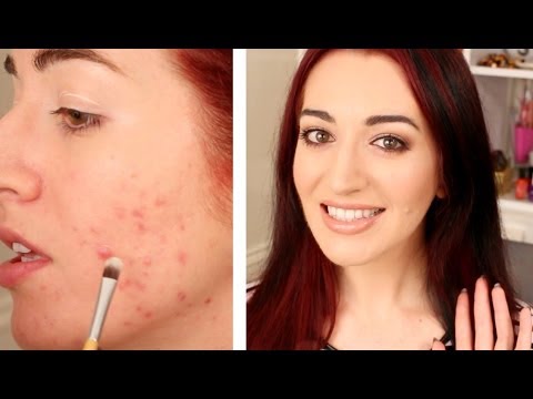 how to best cover up acne