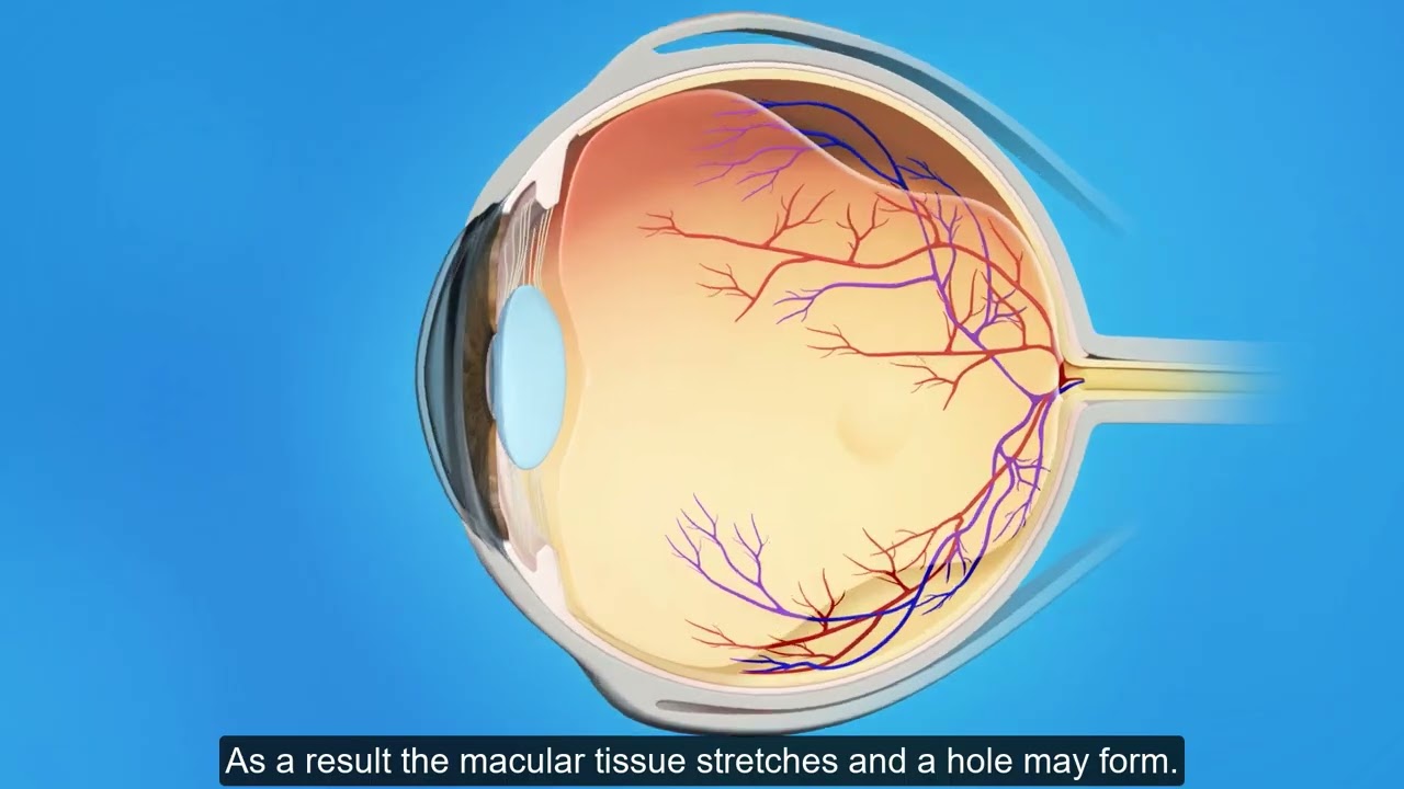 Retina Macular Hole Surgery