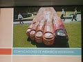 Diabetes Mellitus10 - Pié diabético, Infecciones