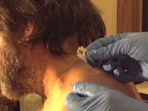 how to to remove skin tags