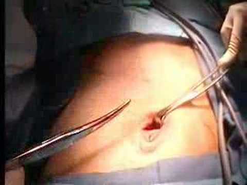 Right Inguinal Hernia Surgery - Part 3