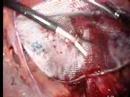 Right Inguinal Hernia Surgery - Part 3 Right Inguinal Hernia Surgery - Part 3