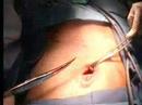 Right Inguinal Hernia Surgery - Part 3