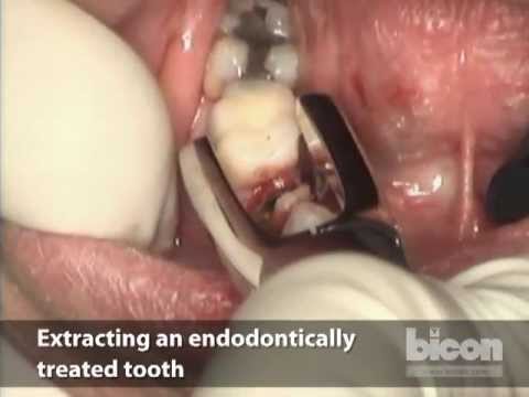 TOOTH!! - On February 8, 2010, Bicon presented a webcast featuring a live demonstration by Doctor Shadi Daher to practitioners around the world. The demonstration incl...