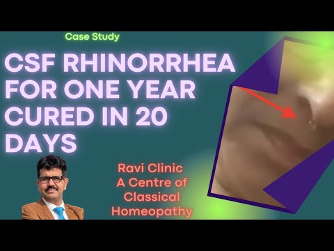 CSF Rhinorrhea For one year Cured in 20 days with Homeopathy Dr Ravi Singh