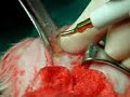 Comparison between micro-bone-saw and ultrasonic bone-saw  Sinusitis Conventional Medicine
