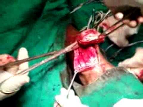 SIFT TISSUSE TUMOUR ON LEFT LEG MIDDILE PORTION [flv mp3].flv