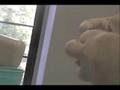 Somnomed mandibular advancement device fitting part 1