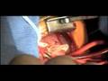 Arterial Switch Procedure - Pediatric Heart Surgery