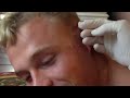 Huge Face Cyst Popped - And he calls himself a Marine