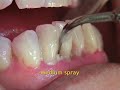 Instructional video on the 1-S tip
