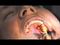 removing rpe