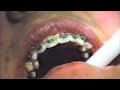 Removing RPE