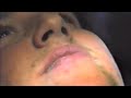 removing rpe