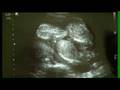 All Sextuplets Born To Local Couple Die