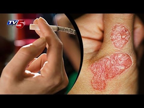 how to cure fissure