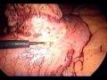 laparoscopic wide excision of GIST