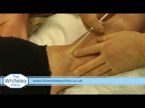 how to treat axillary hyperhidrosis