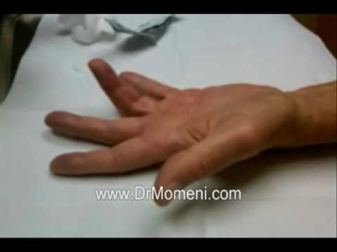 how to treat jersey finger