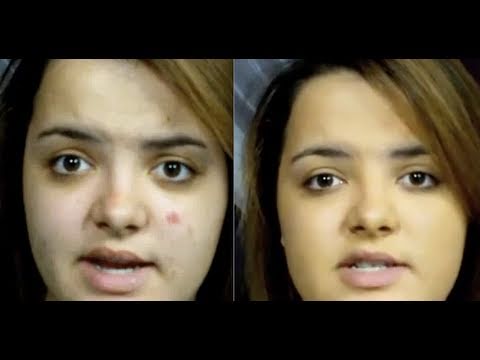 how to get rid of a acne scab