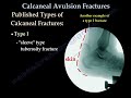 Calcaneus fracture achillis tendon animation video .Educational video describing avulsion fractures of the calcaneal tuberosityand interruption of the achillis tendon function Specific classification and fixation methods are described.urgent treatment with reduction and fixation is important to avoid skin complication and to restore the function of the achillis tendon .this video is created by university of toledo orthopedic surgeon.