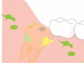 some general problems and risks removing wisdom teeth in an animated film