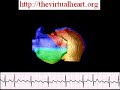 Atrial flutter, simulation in an anatomical human atria Atrial flutter, simulation in an anatomical human atria