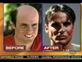 Virtual Reality Hair Replacement for Men