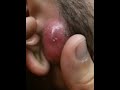 Little puss popper. Infection