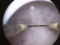 Derin Septum Prof Dr Bülent Urman www.bulenturman.com