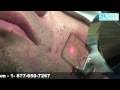 Rid Acne Scars