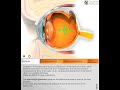 Glaucoma 3D: Quantel Medical