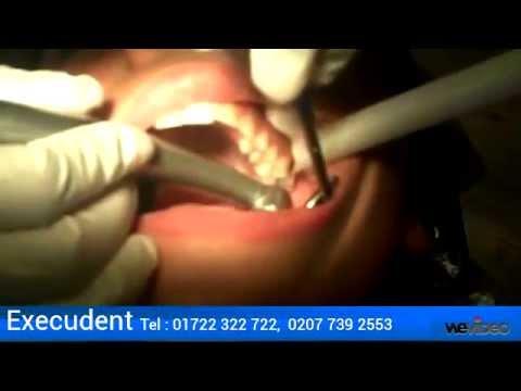 how to whiten teeth if you have fillings