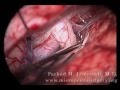 Left Supraorbital Craniotomy