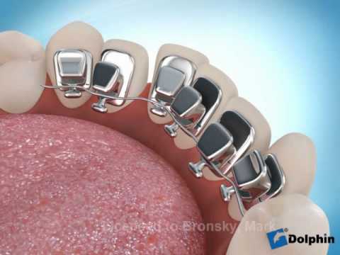 Lingual Ortodonti (içten tel tedavisi)