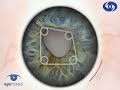 The Malyugin Ring Phaco 3.1 Complications The Malyugin Ring Phaco 3.1 Complications