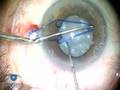 videos de The Malyugin Ring Phaco 3.1 Complications