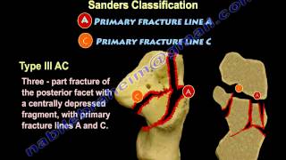 Calcaneal Intra-Articular Fractures, Sanders - Everything You Need To Know - Dr. Nabil Ebraheim
