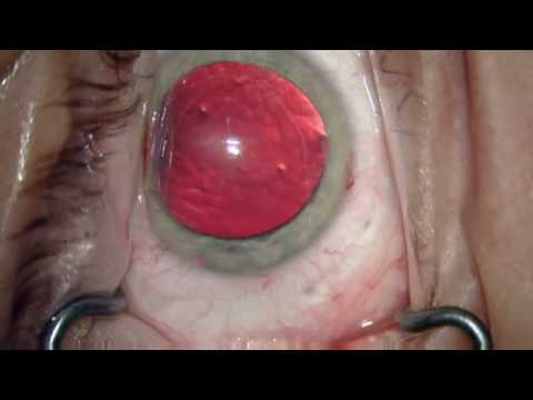 accommodating intraocular lens. Visian ICL (Intraocular Contact Lens) is the latest alternative to LASIK, SBK, and Epi-LASIK. The Staar Collamer Phakic Implant corrects 3 to 16 diopters of 